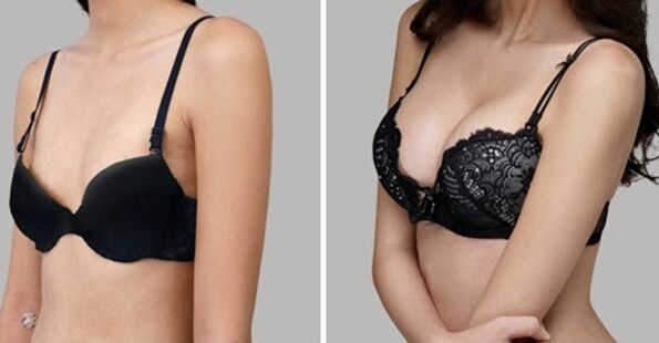 avant et après augmentation mammaire