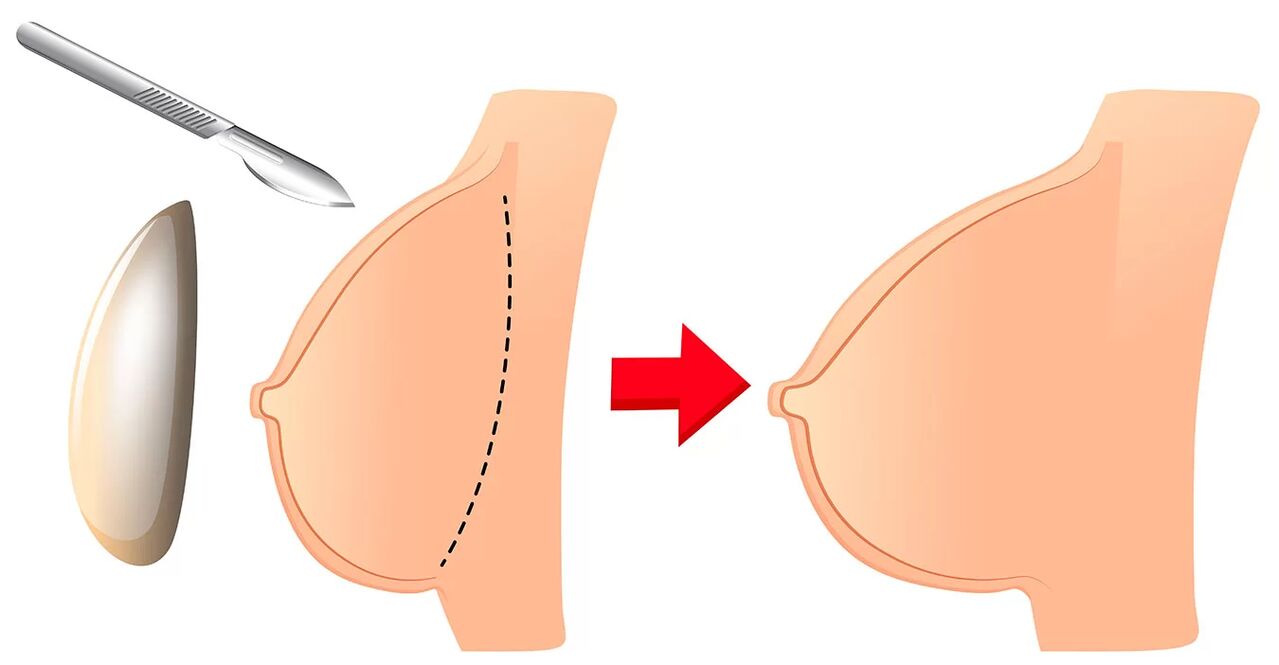 Augmentation mammaire avec implant